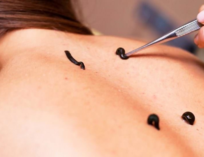 Гирудотерапия - Оздоровительные услуги - Санаторий «Вилла Арнест» Кисловодск